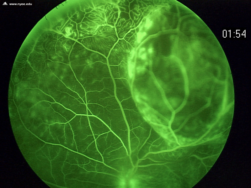 Coats' Disease (3 of 7) NYEE